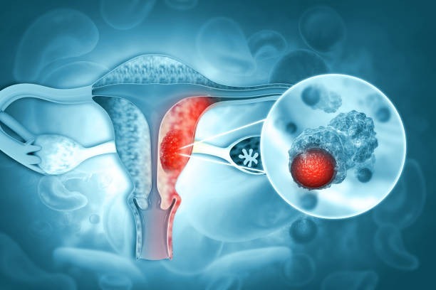 El Cáncer cervicouterino es prevenible en un 99%, pero sigue cobrando miles de vidas. El arte de disfrutar con estilo y sentido.