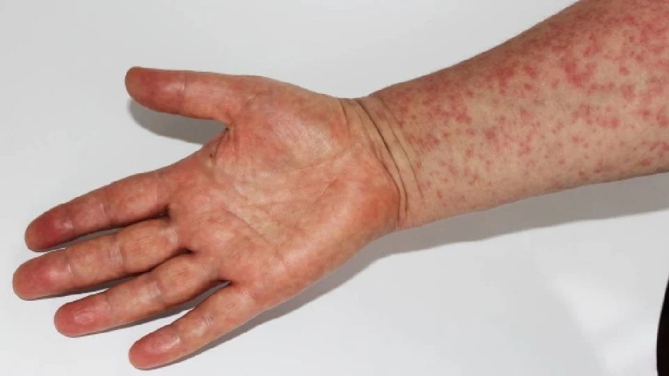 Sarampión en México: fallece niño de un año que no estaba vacunado en Tlaxcala